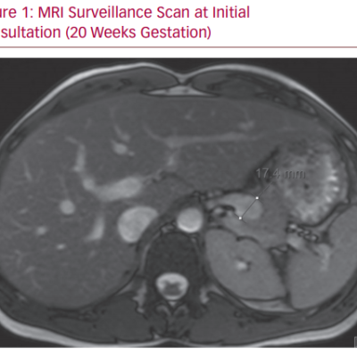 MRI Surveillance Scan at Initial Consultation