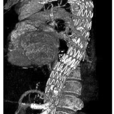 CT scan stent graft subclavian orifice to aortic bifurcation