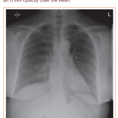 Posteroanterior Chest X-ray Showing an 11 mm Opacity Over the Heart