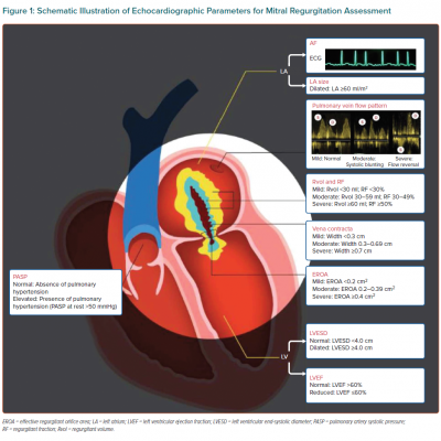 Schematic Illustration of Echocardiographic Parameters for Mitral Regurgitation Assessment 