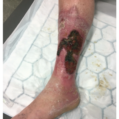Severe Post-thrombotic Syndrome