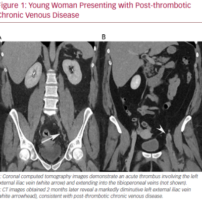 Young Woman Presenting with Post-thrombotic