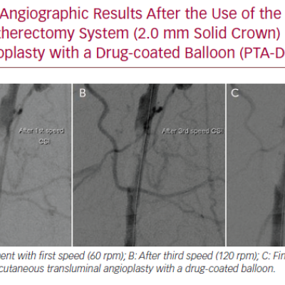 Angiographic Results After the Use of the Orbital Atherectomy System