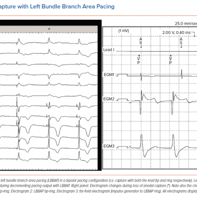 Anodal Capture with Left Bundle Branch Area Pacing