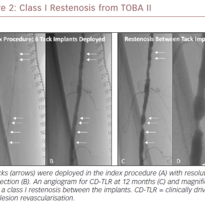 Class I Restenosis from TOBA II