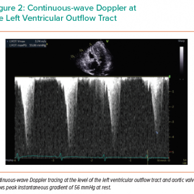 Continuous-wave Doppler at the Left Ventricular Outflow Tract