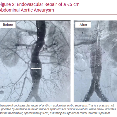 Endovascular Repair of a &amplt5 cm Abdominal Aortic Aneurysm