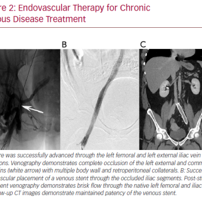 Endovascular Therapy for Chronic Venous Disease Treatment