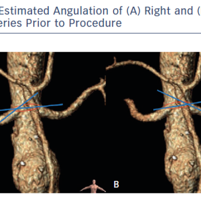 Estimated Angulation of A Right and B Left Renal Arteries Prior to Procedure
