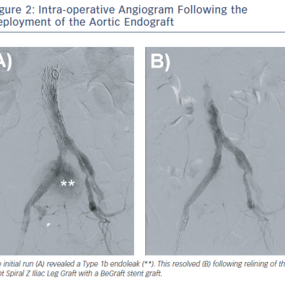 Intra-operative Angiogram Following the Deployment of the Aortic Endograft