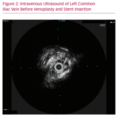  Intravenous Ultrasound of Left Common Iliac Vein