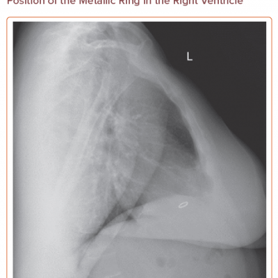 Lateral Chest X-ray Confirming the Position of the Metallic Ring in the Right Ventricle
