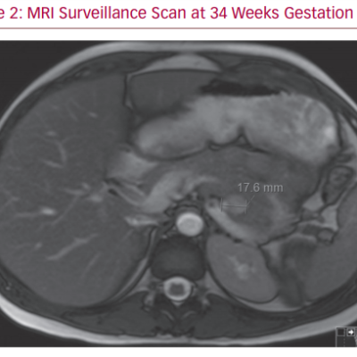 MRI Surveillance Scan at 34 Weeks Gestation