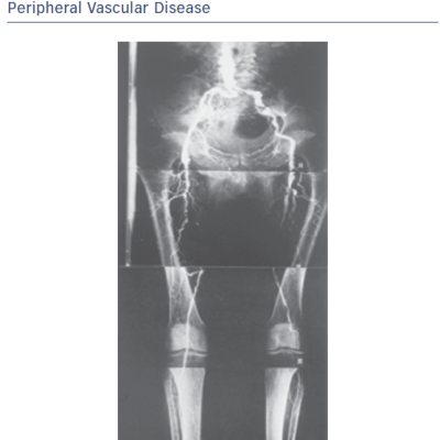 X-ray Showing Extensive Damage Caused by Peripheral Vascular Disease