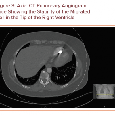 Axial CT Pulmonary Angiogram Slice Showing the Stability of the Migrated Coil in the Tip of the Right Ventricle
