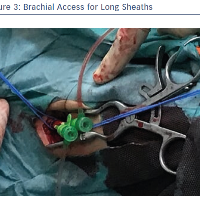 Brachial Access for Long Sheaths