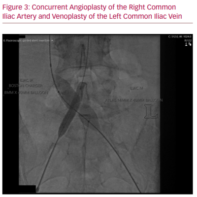 Concurrent Angioplasty of the Right Common Iliac
