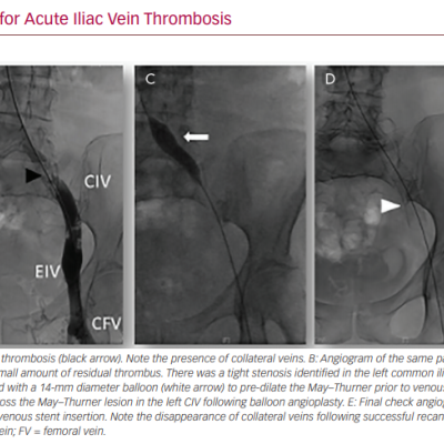 Endovascular Therapy for Acute Iliac Vein Thrombosis