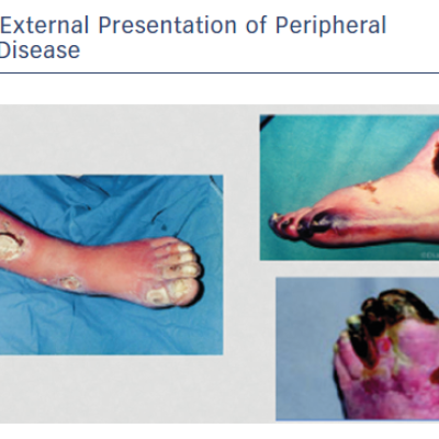 External Presentation of Peripheral Vascular Disease