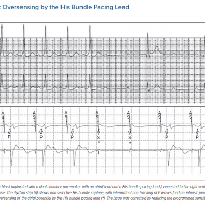 Intermittent Oversensing by the His Bundle Pacing Lead