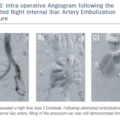 Intra-operative Angiogram following the Attempted Right Internal Iliac Artery Embolization Procedure