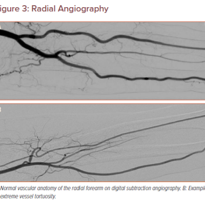 figure 3-radial-angiography