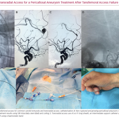 Right Transradial Access for a Pericallosal Aneurysm