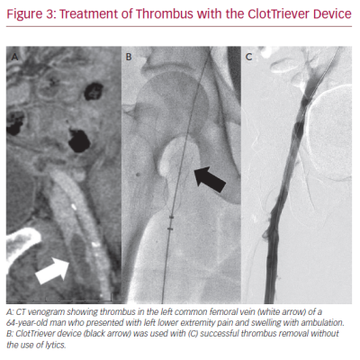Treatment of Thrombus with the ClotTriever Device