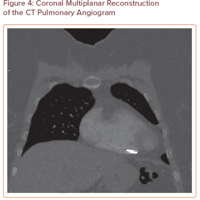 Coronal Multiplanar Reconstruction of the CT Pulmonary Angiogram