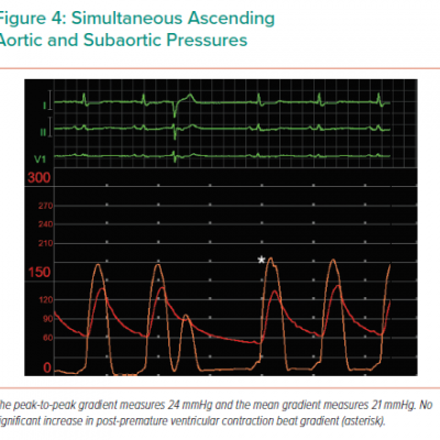 Simultaneous Ascending Aortic and Subaortic Pressures