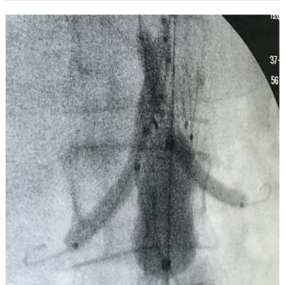 Simultaneus Balloning of Aortic Stentgraft and Renal-covered Stents Using Kissing Balloon Technique