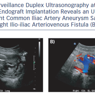 Surveillance Duplex Ultrasonography at 6 Months’ Post-Aortic Endograft Implantation Reveals an Unchanged Residual Right Common Iliac Artery Aneurysm Sac A and a Persisting Right Ilio-iliac Arteriovenous Fistula B