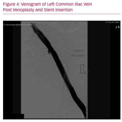 Venogram of Left Common Iliac Vein