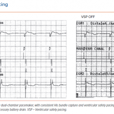 Ventricular Safety Pacing