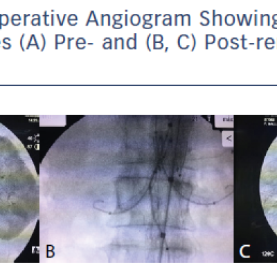 Intraoperative Angiogram Showing Position of Renal Arteries A Pre- and B C Post-renal Stent Deployment