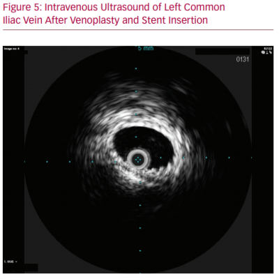 Intravenous Ultrasound of Left Common Iliac Vein