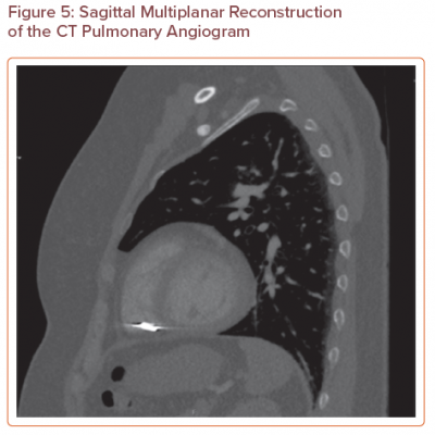 Sagittal Multiplanar Reconstruction of the CT Pulmonary Angiogram