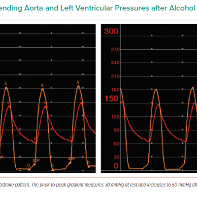 Simultaneous Ascending Aorta and Left Ventricular Pressures after Alcohol Septal Ablation