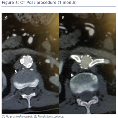 CT Post-procedure 1 month
