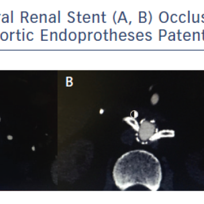 Bilateral Renal Stent A B Occlusion with C Bifurcated Aortic Endoprotheses Patent