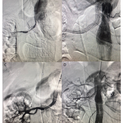 Right Renal Stent Rescue and Relining