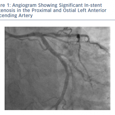 Angiogram Showing Significant In-stent Restenosis in the Proximal and Ostial Left Anterior Descending Artery