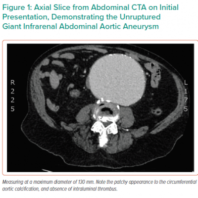 Axial Slice from Abdominal CTA on Initial Presentation Demonstrating the Unruptured Giant Infrarenal Abdominal Aortic Aneurysm