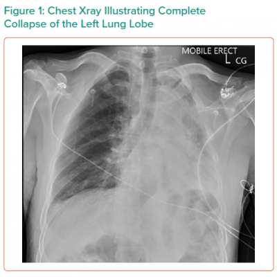 Chest Xray Illustrating Complete Collapse of the Left Lung Lobe