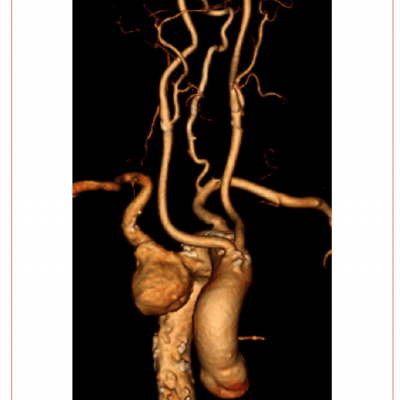 CT Reconstruction Illustrating Kommerell’s Diverticulum and an Aberrant Right Subclavian Artery