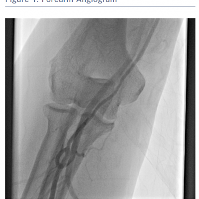 Forearm Angiogram