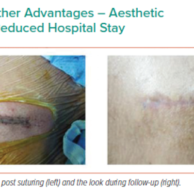 Other Advantages – Aesthetic Look and Reduced Hospital Stay