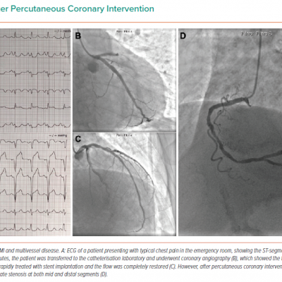 Stenosis After Percutaneous Coronary Intervention