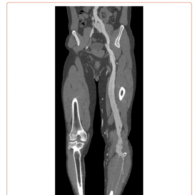 3D Reconstruction of Lower Limb CT Angiography Showing Left Leg Arterial and Venous Dilation with Extensive Venous Varicosities in the Left Calf