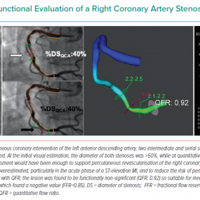 Angiographic and Functional Evaluation of a Right Coronary Artery Stenosis